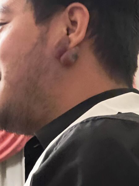 File:Keloid.jpg