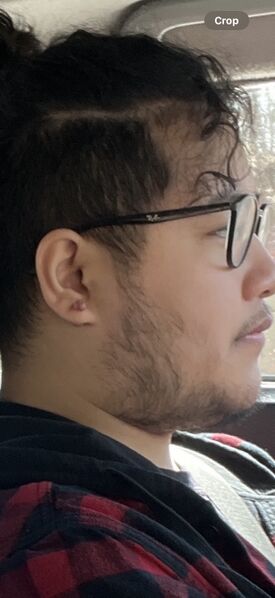 File:EarlyKeloid.jpg